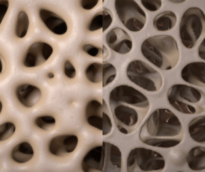 Kaulu struktūra. No kreisās: normāla kaula uzbūve, osteoporozes skarts kauls. Avots: pexels.com